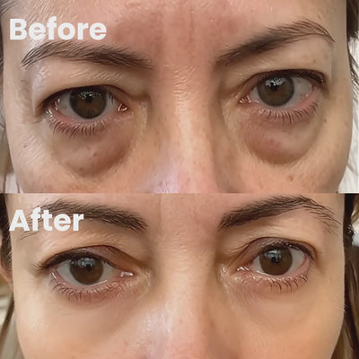 RAVIDI™ Eye Lifting